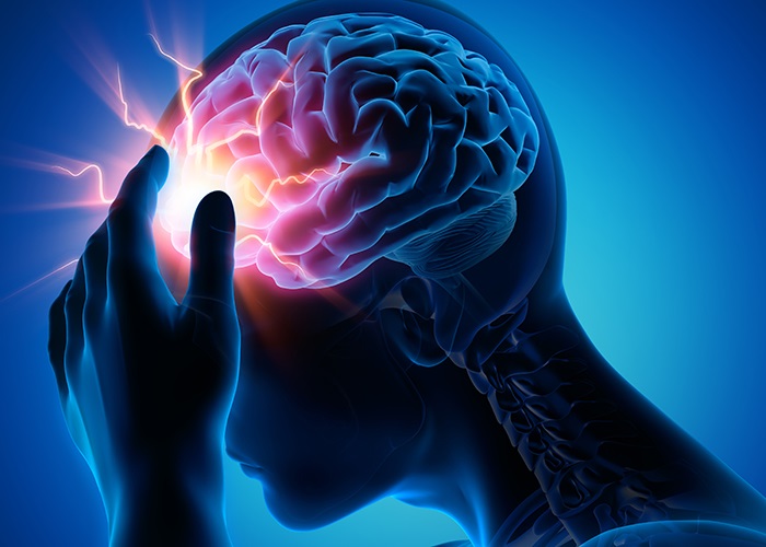 Starke Kopfschmerzen - Migräne - Medizinische Illustration - 3D Rendering